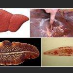 Черви в печени человека: симптомы паразитарного заражения